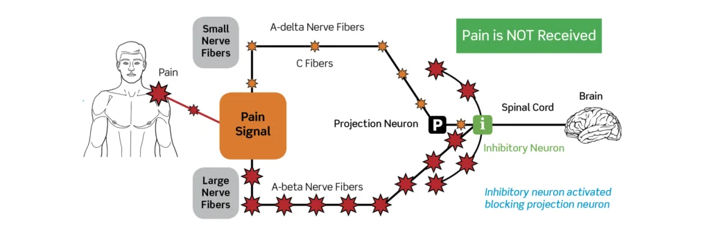 Gate-Control Theory of Pain