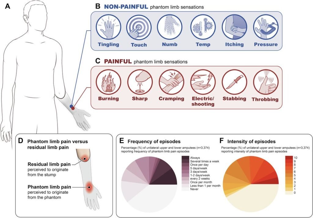 Phantom Limb Phenomena in Psychology and Medicine: A Comprehensive Guide